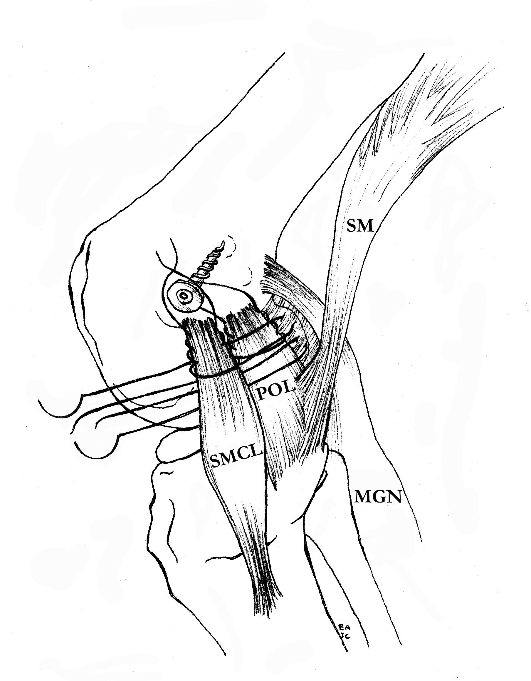 MCL Femoral fixation 3